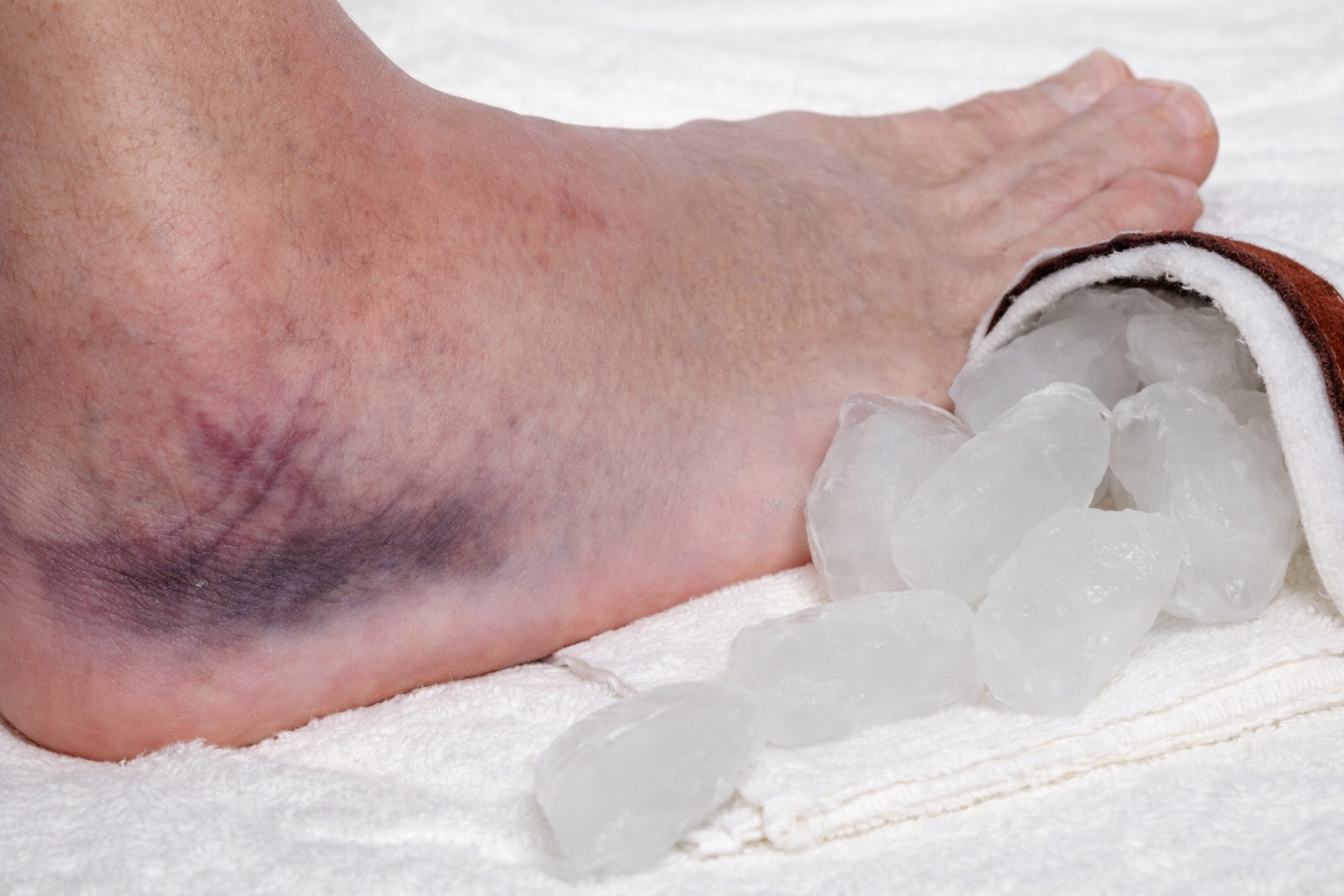 Sprained Ankle – Treatment and Prevention