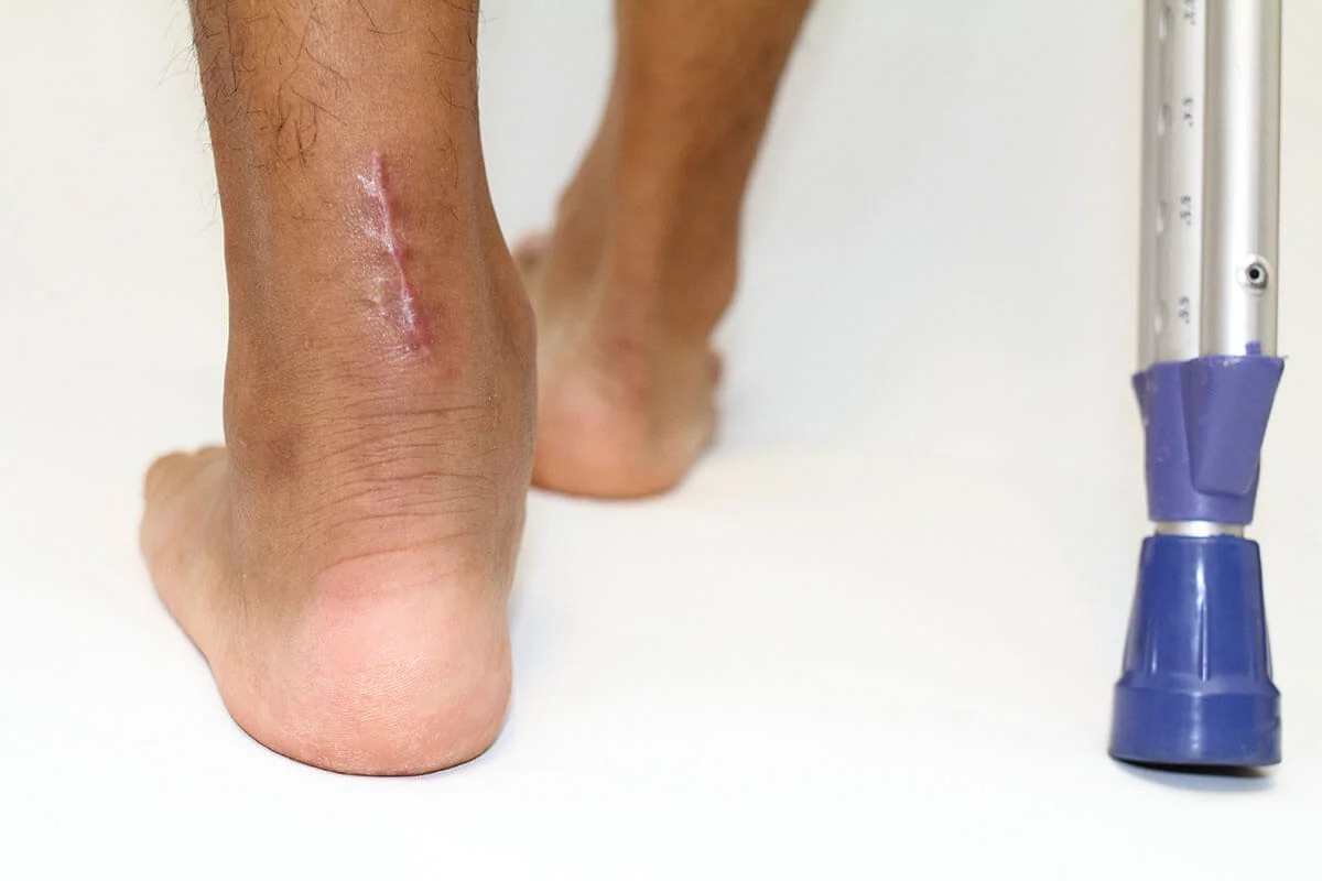 Achilles Tendon Rupture – Conservative vs Surgery Management